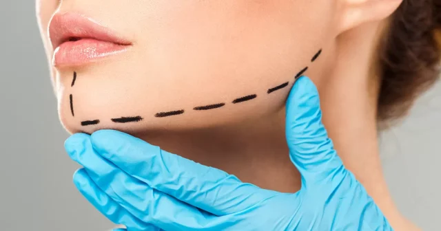 Chin Correction (Cosmetic Chin Surgery)