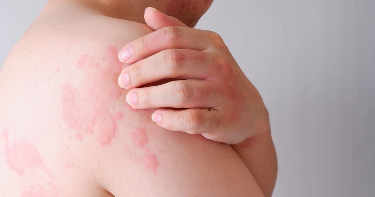 แพ้ยาเพนิซิลลินอันตรายมากแค่ไหน