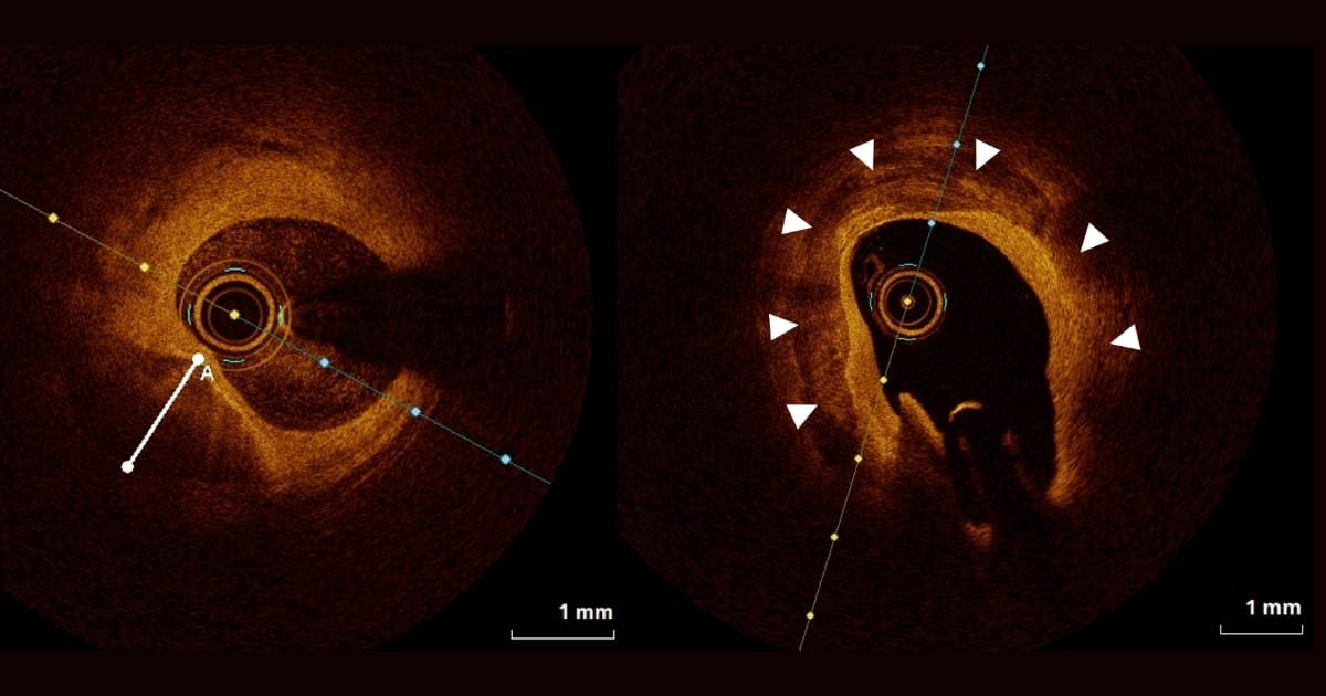 IVL (IntraVascular Lithotripsy) คลื่นกระแทกหินปูนในหลอดเลือดหัวใจผ่านสายสวน