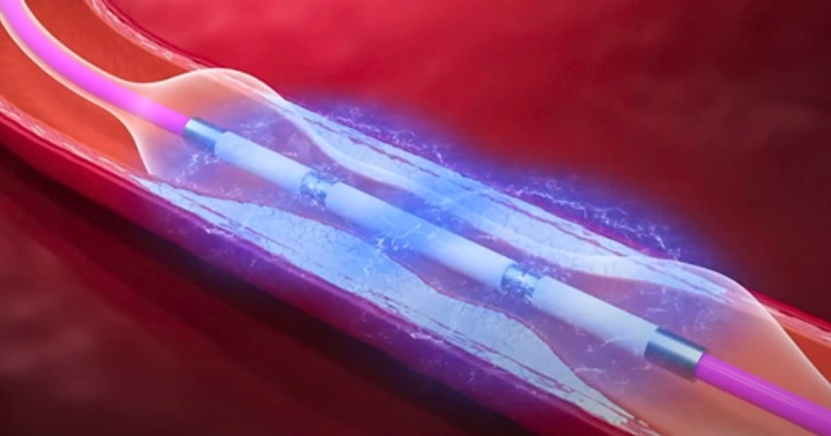 IVL (IntraVascular Lithotripsy) คลื่นกระแทกหินปูนในหลอดเลือดหัวใจผ่านสายสวน