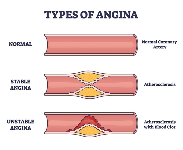 โรคหลอดเลือดหัวใจตีบ รู้ให้ลึกก่อนตัดสินใจรักษา