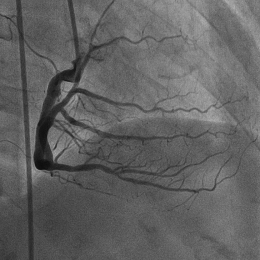 โรคหลอดเลือดหัวใจตีบ รู้ให้ลึกก่อนตัดสินใจรักษา