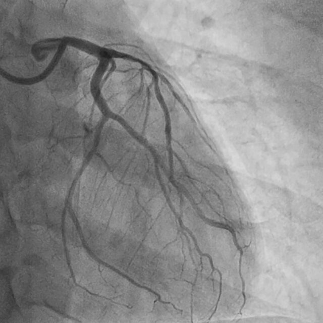 โรคหลอดเลือดหัวใจตีบ รู้ให้ลึกก่อนตัดสินใจรักษา