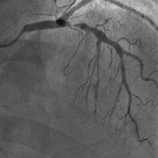 โรคหลอดเลือดหัวใจตีบ รู้ให้ลึกก่อนตัดสินใจรักษา