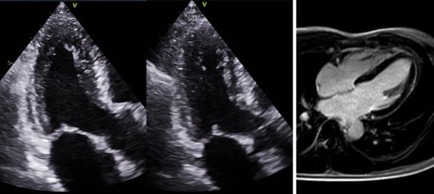 โรคหลอดเลือดหัวใจตีบ รู้ให้ลึกก่อนตัดสินใจรักษา