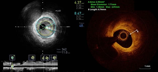 โรคหลอดเลือดหัวใจตีบ รู้ให้ลึกก่อนตัดสินใจรักษา