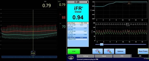 โรคหลอดเลือดหัวใจตีบ รู้ให้ลึกก่อนตัดสินใจรักษา