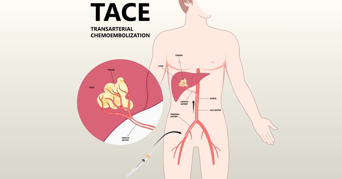 มะเร็งตับรักษาได้ด้วยเคมีบำบัดทางหลอดเลือดแดง