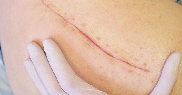 Scar Revision