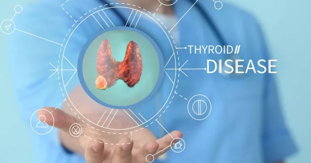 การรักษาต่อมไทรอยด์ ด้วยวิธีการผ่าตัด Image