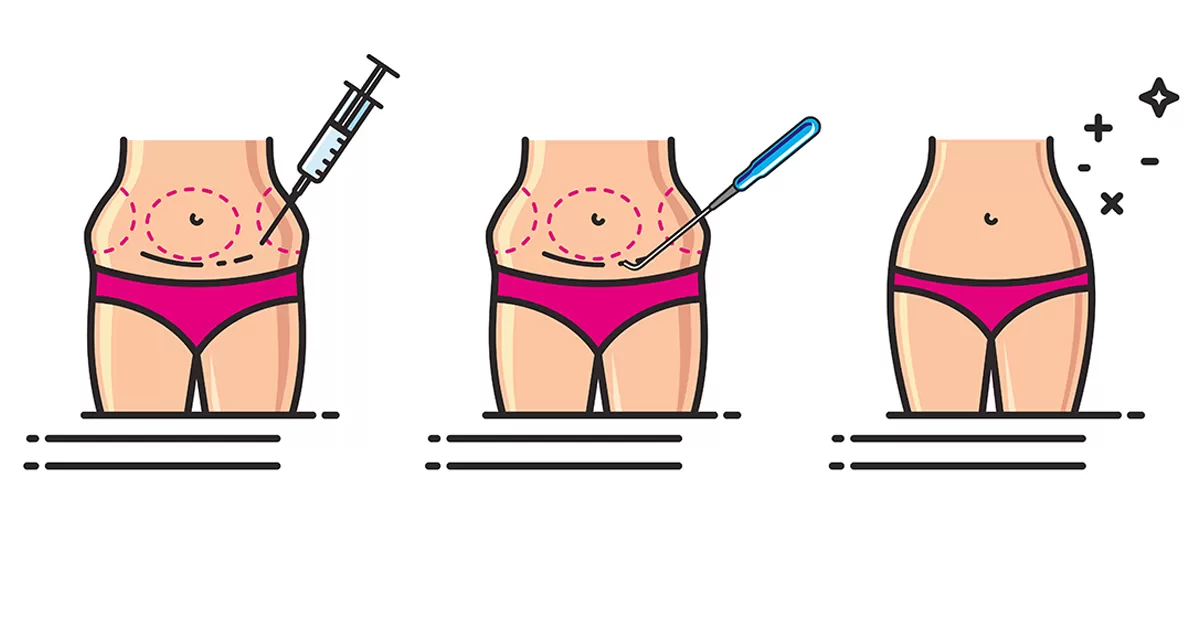 How Does Liposuction Work?