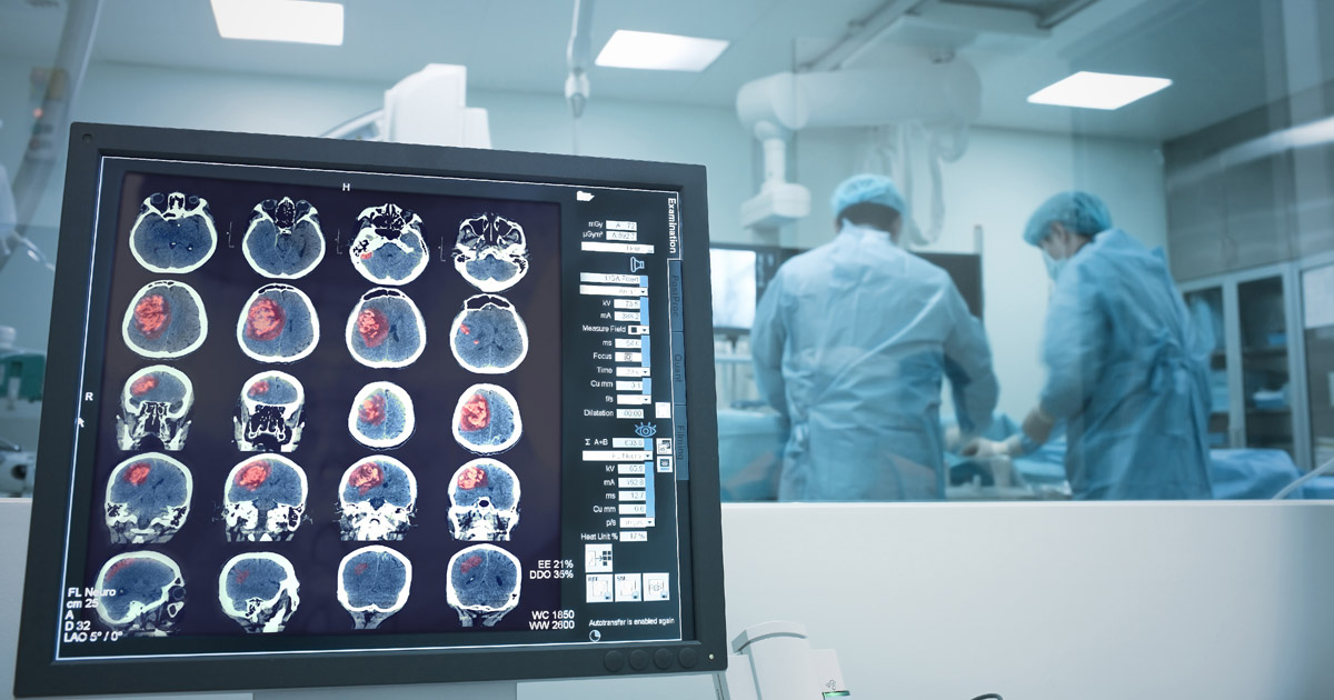 MechanicalThrombectomy1