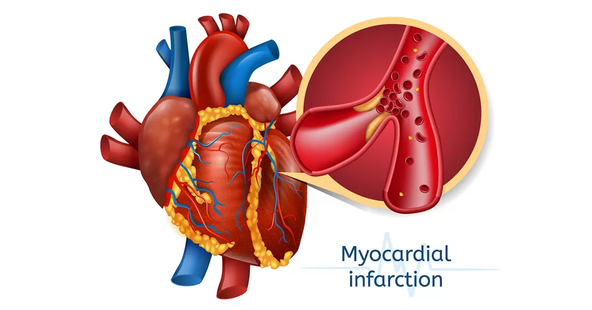 myocardial infarction