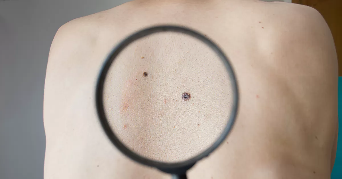 มะเร็งผิวหนัง อาการ