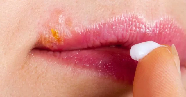 เริม... ไม่ใช่แค่ "ตุ่มใส" แต่เป็น "ไวรัสซ่อนเร้น" ที่ใครก็เป็นได้! Image