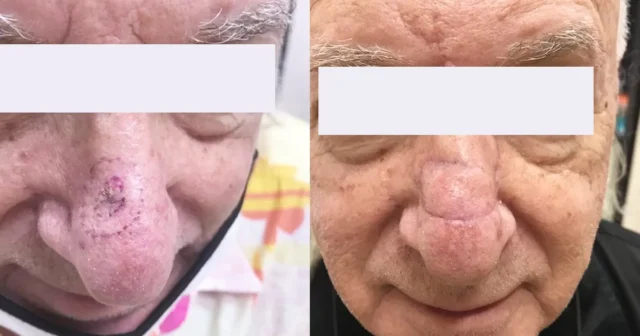 皮肤癌 - 冷冻切片 Image