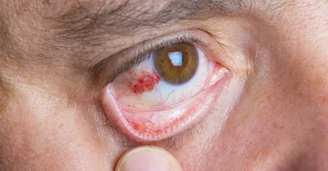 Conjunctivitis (Red eye) Image