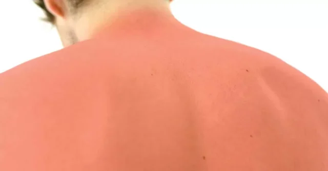 Verbrennungen: Einige vernünftige Ratschläge Image