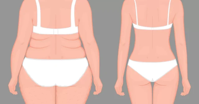 Liposuction