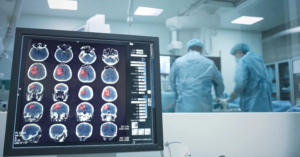 MechanicalThrombectomy