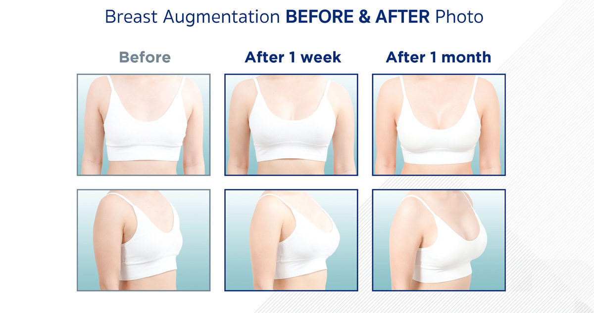 breast augmentation before after