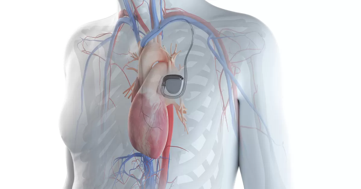 pacemaker