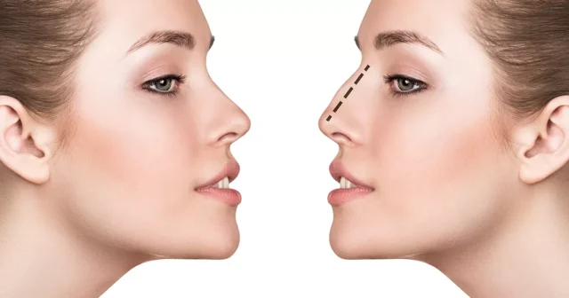 Rhinoplasty (Nose Job)