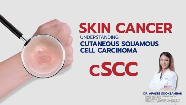 Skin cancer:Understanding Cutaneous Squamous Cell Carcinoma (cSCC) Image
