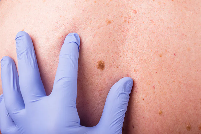 การตรวจคัดกรองมะเร็งผิวหนัง