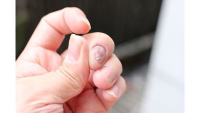 โรคเชื้อราที่เล็บ Image