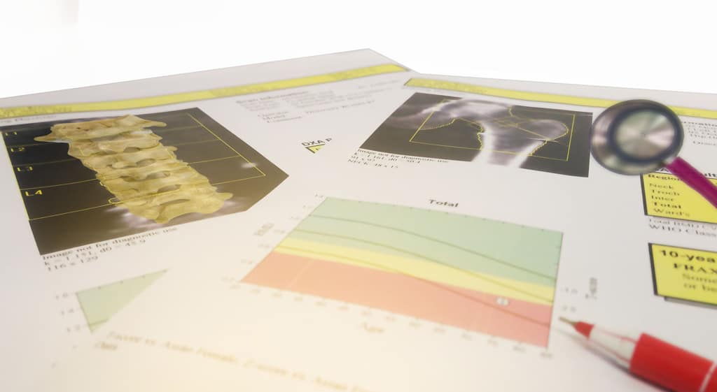 โรคกระดูกพรุน