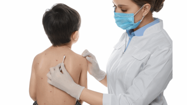 โรคอีสุกอีใส (Chickenpox/Varicella) Image