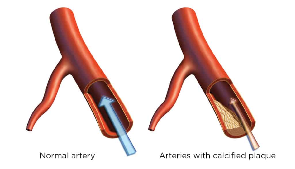Coronary Artery Calcium Scoring