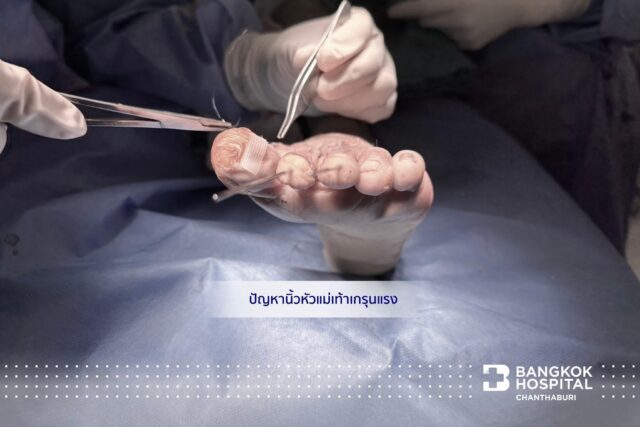 การผ่าตัดรักษานิ้วหัวแม่เท้าเกรุนแรง (Hallux Valg) Image