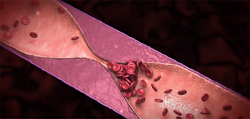 เส้นเลือดในตาที่เกิดการอุดตัน