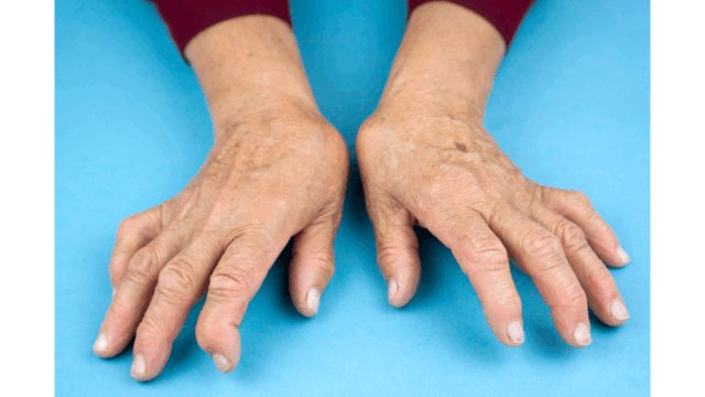 โรคข้อรูมาตอยด์ Image