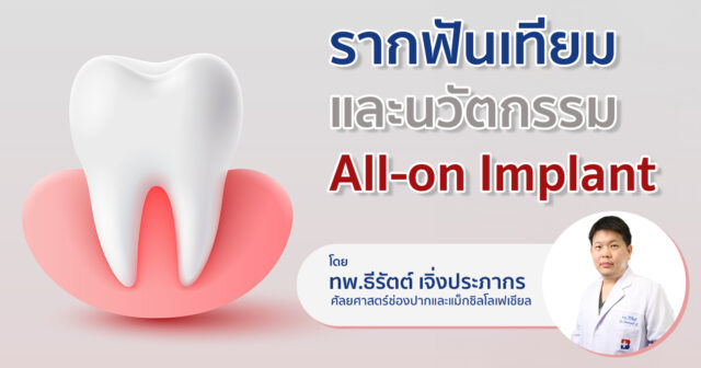 เจาะลึก "รากฟันเทียม" และนวัตกรรม "All-on Implant" Image