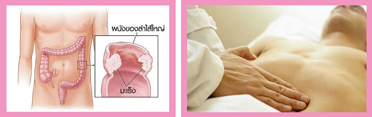 มะเร็งลำไส้ใหญ่ ตรวจเจอเร็ว รักษาได้