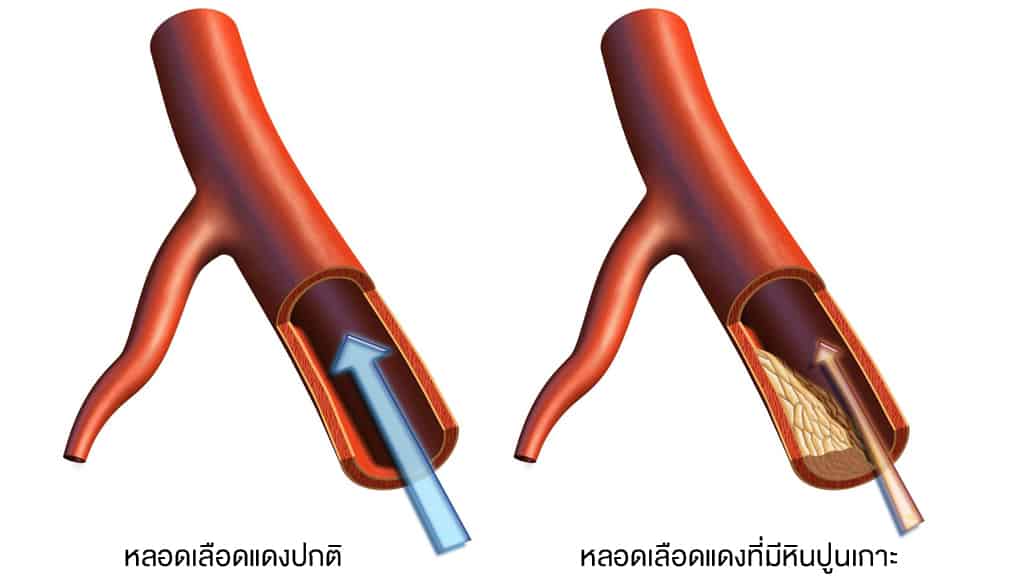การตรวจคราบหินปูนในหลอดเลือดหัวใจ