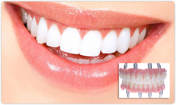 ทันตกรรมรากฟันเทียม All-on-4 และ All-on-6