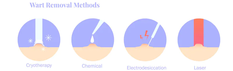 เป็นหูดหายได้ ถ้ารักษาอย่างถูกต้อง