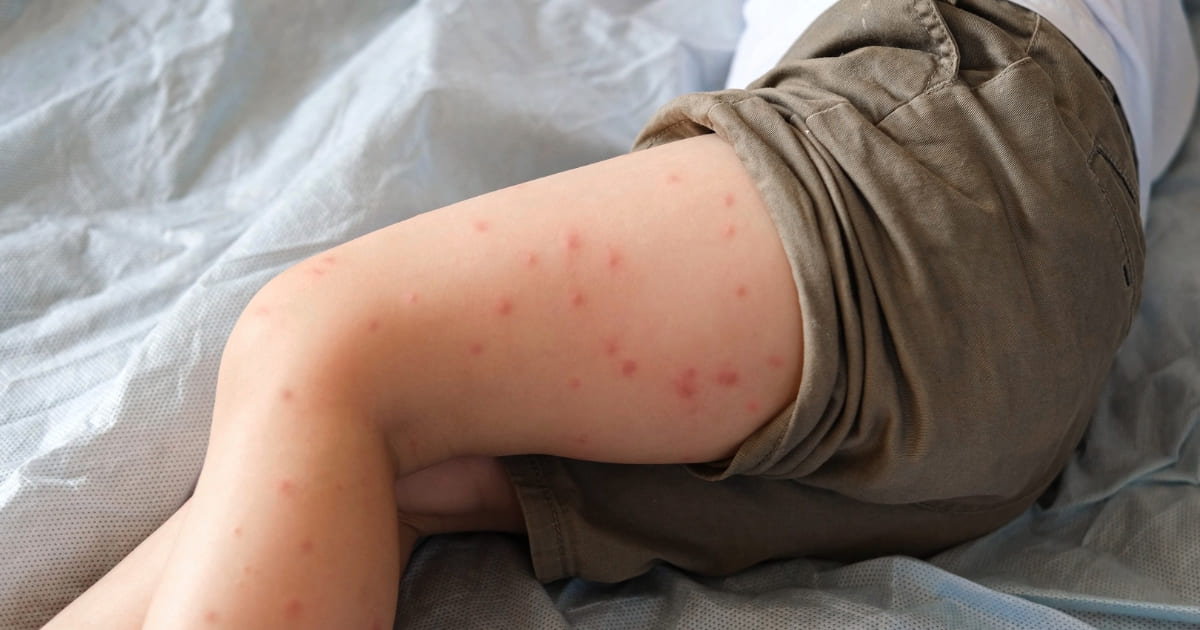 ไข้เลือดออกในเด็ก อาการอันตรายที่พ่อแม่ต้องรู้