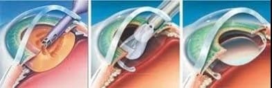 Refractive Lens Exchange (RLE) ผ่าตัดเปลี่ยนเลนส์แก้สายตาให้มองชัดทุกระยะ