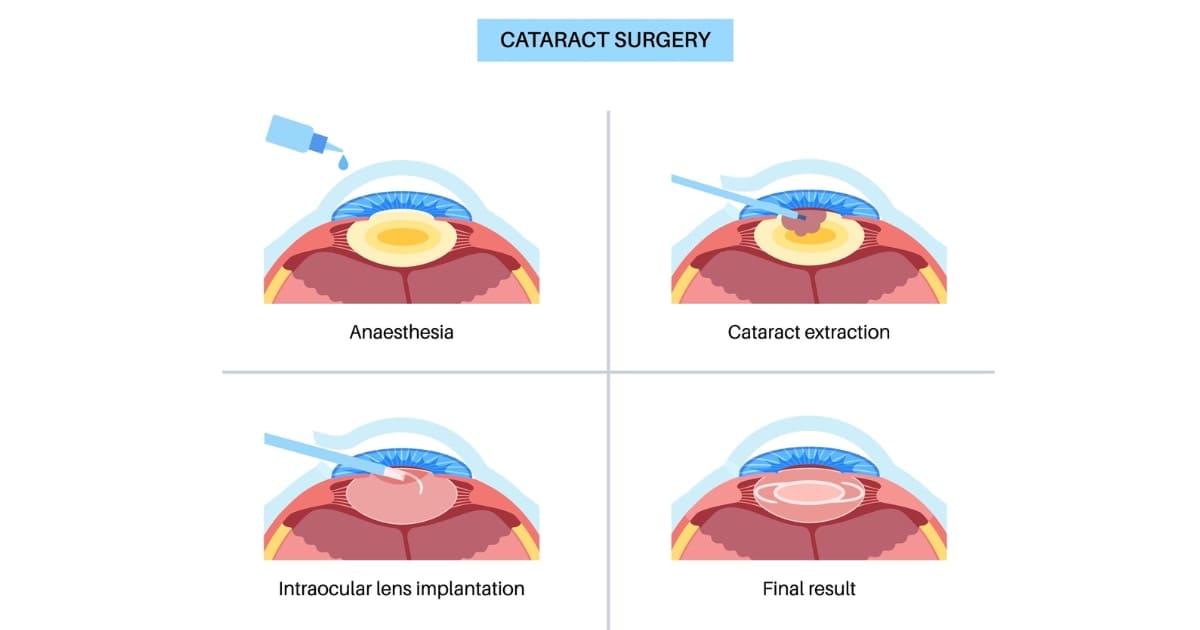 สลายต้อกระจกใส่เลนส์แก้วตาเทียม (IOL) ตอบโจทย์การใช้ชีวิต
