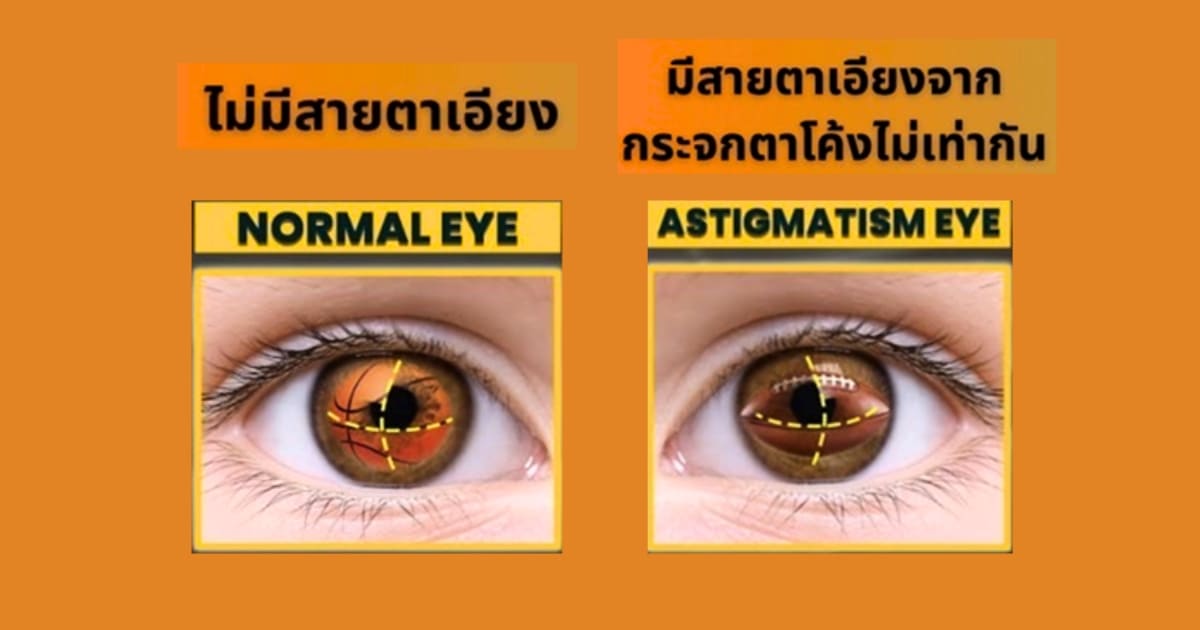 สลายต้อกระจกใส่เลนส์แก้วตาเทียม (IOL) ตอบโจทย์การใช้ชีวิต