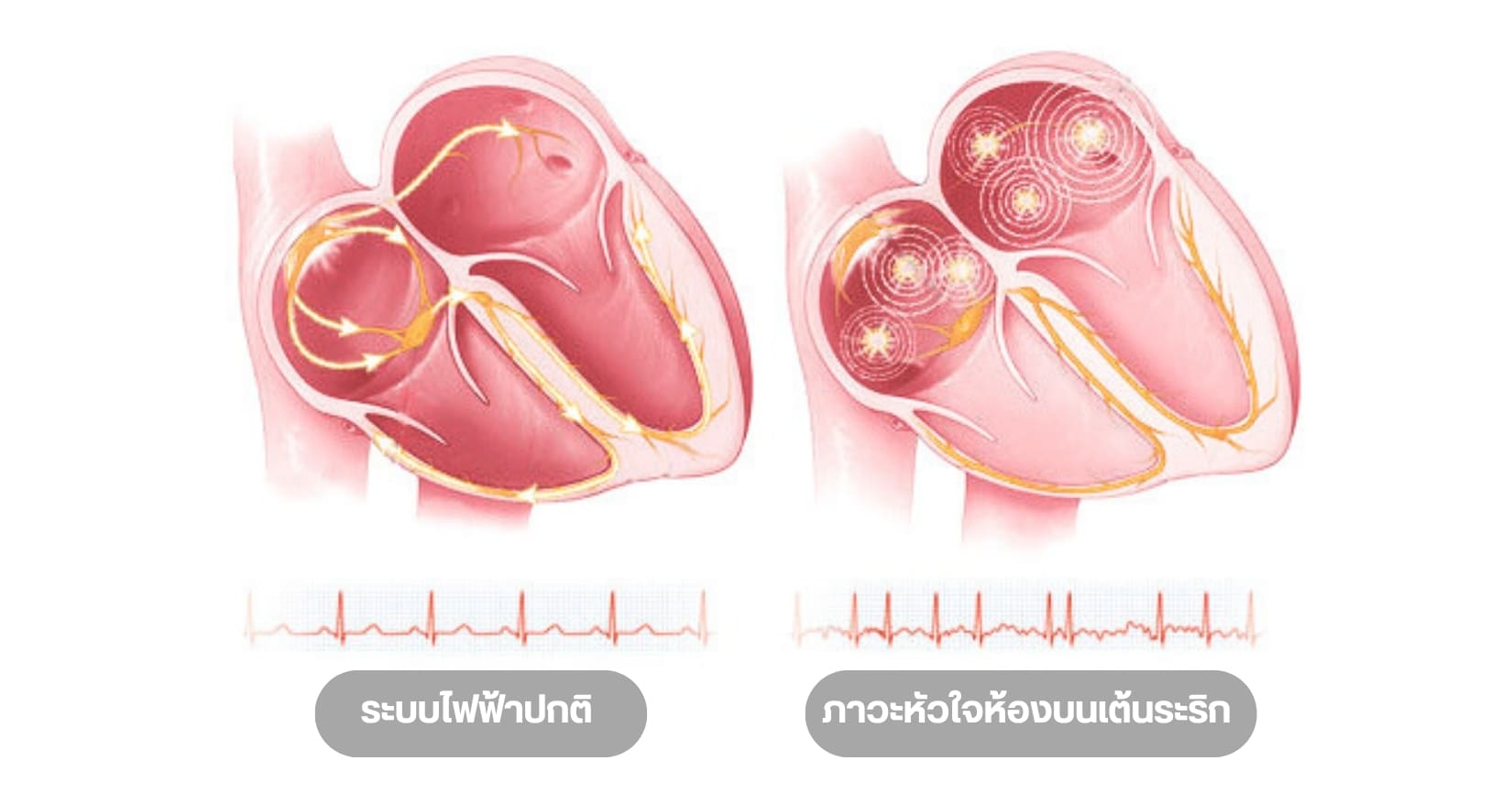 จี้ไฟฟ้าหัวใจด้วยเทคโนโลยี PFA