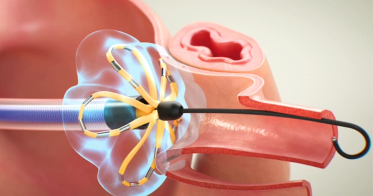 จี้ไฟฟ้าหัวใจด้วยเทคโนโลยี PFA
