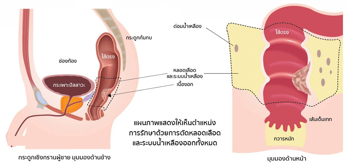 Rectal Cancer Banner