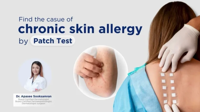 หาสาเหตุของผื่นแพ้เรื้อรัง โดยการทดสอบภูมิแพ้ผิวหนัง แบบแผ่นแปะ (Patch Test) Image