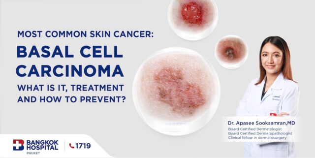 Most common skin cancer: Basal cell carcinoma, what is it, treatment and how to prevent? Image